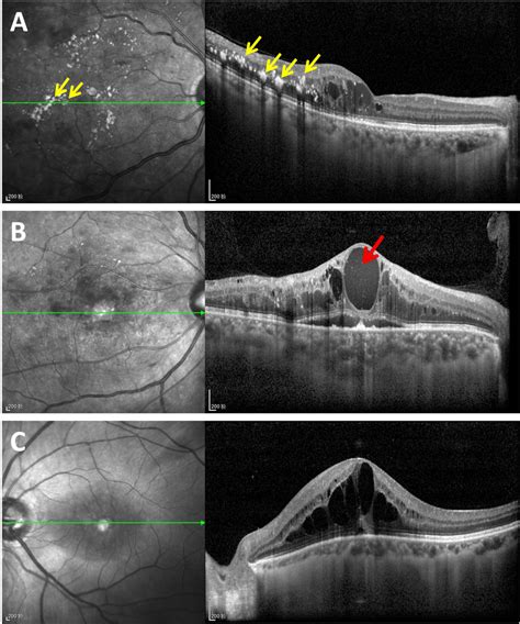 Representative SD-OCT images of macular edema secondary to different... | Download Scientific ...