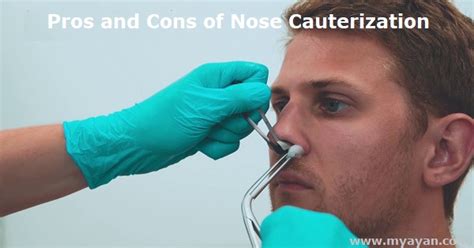 Pros and Cons of Nose Cauterization - Minor Procedure