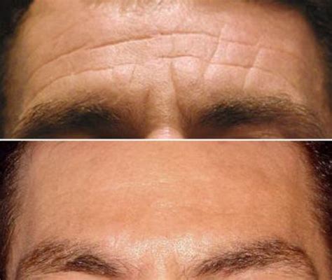 Forehead | Frown | Glabella line anti-wrinkle treatment