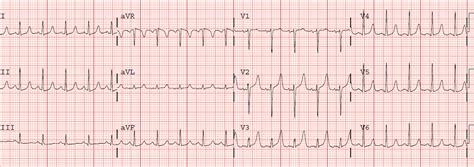 Dr. Smith's ECG Blog: Slightly Peaked T-waves, What is it?