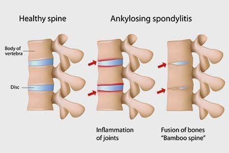 Spondyloarthritis or Ankylosing Spondylitis: Types Symptoms Causes Treatment