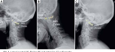 Figure 1 from Cervical spine instability in the course of rheumatoid arthritis – imaging methods ...