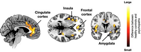 Psychopathic Brain Scans