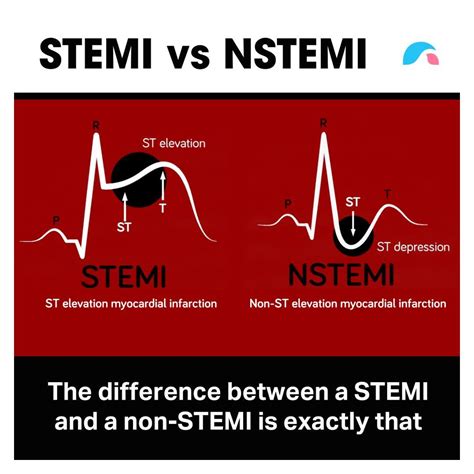 Stemi Vs Nstemi Difference | Images and Photos finder