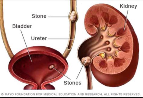 Kidney Stones: Causes, Symptoms, And Available Treatments