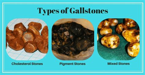 Can You Get Gallstones Without A Gallbladder?