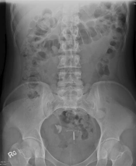 Ovarian torsion caused by teratoma masquerading as renal colic ...