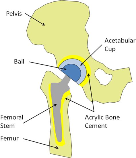 MWCNT Used in Orthopaedic Bone Cements | IntechOpen