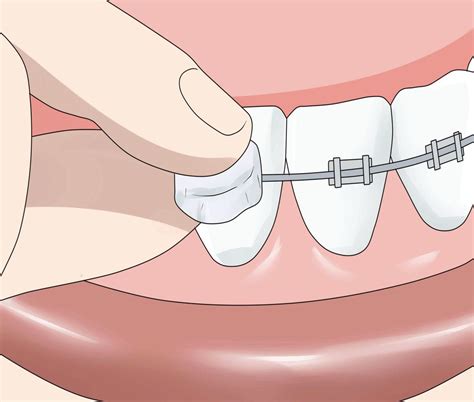 ORTHODONTIC : How to Apply Dental Wax on Braces - Directorio Odontológico