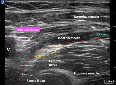 Fascia iliaca block ultrasound injection anesthetic - ALiEM