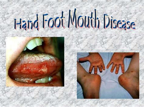 PPT - Hand Foot Mouth Disease PowerPoint Presentation, free download - ID:3543529