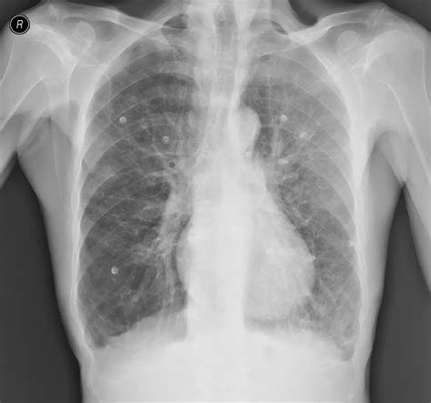 Emphysema: Causes, Symptoms and Treatment | Healthtian