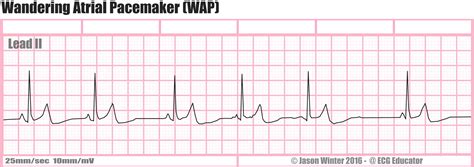 Wandering Atrial Pacemaker Ecg