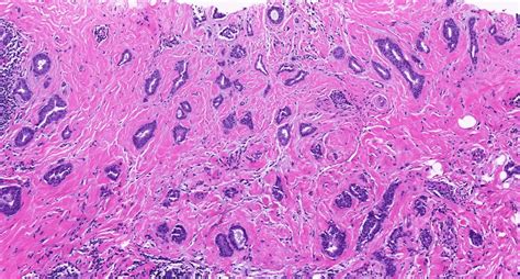 Invasive Ductal Carcinoma Histology