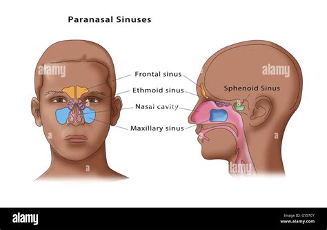 Maxillary And Ethmoid Sinus Disease