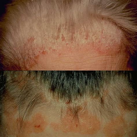 Natural Scalp Psoriasis Treatment With Tea Tree Oil and Olive Oil - HubPages