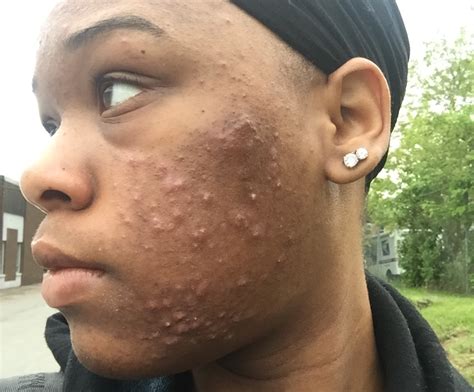 'Skin positivity’ confronts acne stigma - WHYY