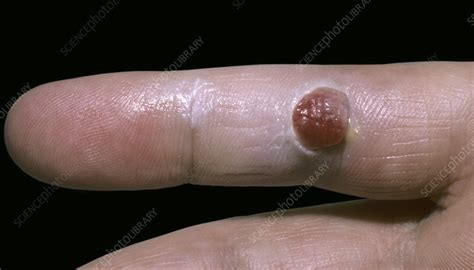 Pyogenic granuloma - Stock Image - C051/5142 - Science Photo Library