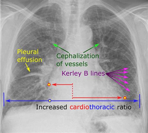 Radiology: Abnormal Chest X-Rays Part II – Glass Box