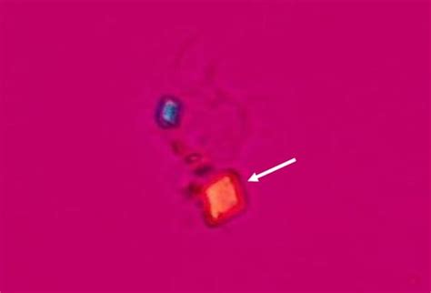 Rhomboid crystals in joint aspirate (Pseudogout) [Calcium pyrophosphate crystals] : Pathognomonic