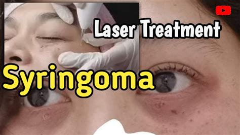 Syringoma Removal | Laser Treatment - YouTube