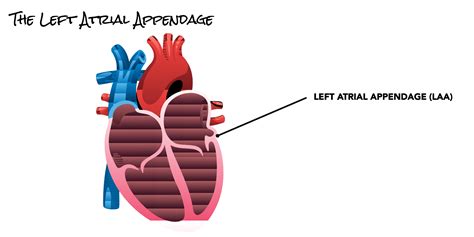 Left Atrial Appendage (LAA) | SCAI - Seconds Count