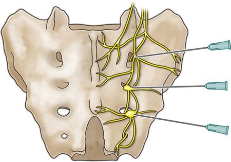 Sacral Sulcus Landmark