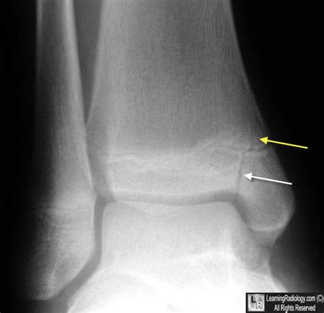 LearningRadiology - Salter, Harris, Fractures, Epiphyseal