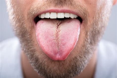 Causes, Effects, and Signs of Fissured Tongue - Facty Health