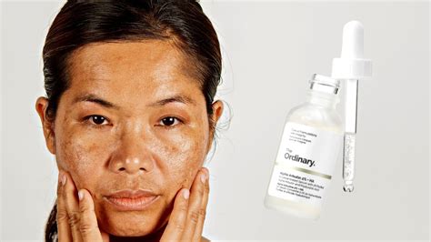 How To Use The Ordinary Alpha Arbutin 2 + HA for Hyperpigmentation ...