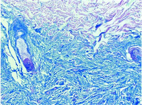 Colloidal iron stain showing greatly increased mucin material in the... | Download Scientific ...