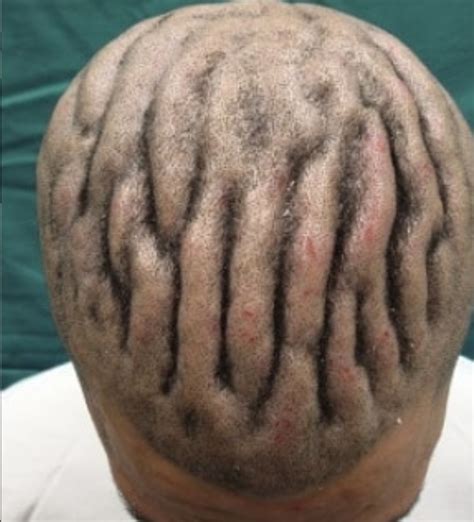 Mounds, ridges, and valleys on the scalp. Spot diagnosis?