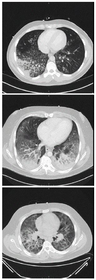 Lipoid pneumonia CT scan - wikidoc