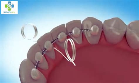 How to Floss with a Permanent Retainer - Smooth Heal