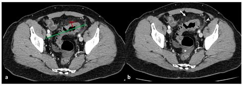 Diagnostics | Free Full-Text | Acute Colonic Diverticulitis: CT Findings, Classifications, and a ...