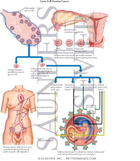 Germ Cell Ovarian Cancer