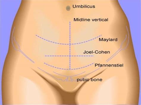 Cesarean Section/Cesarean Delivery – Stepwards