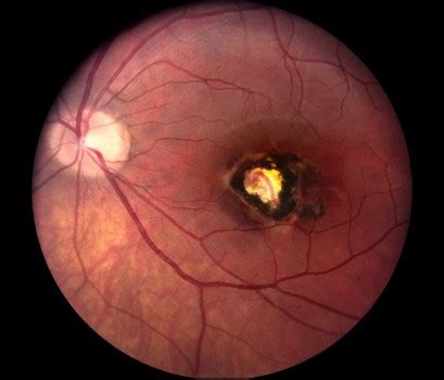 Toxoplasmosis - American Association for Pediatric Ophthalmology and Strabismus