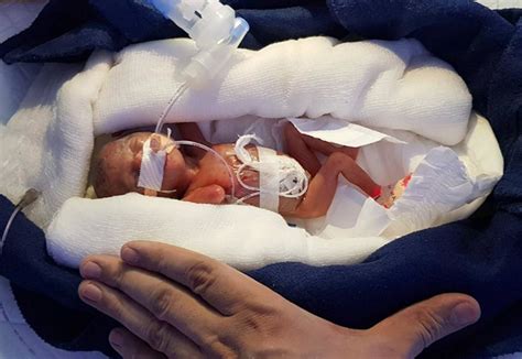 Bebé "milagre" nasceu com 400 gramas às 28 semanas de gravidez, e ...