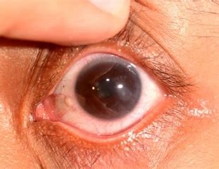 What is Keratitis?