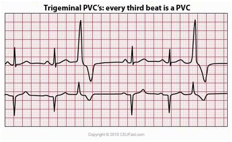 CEUfast.com - trigeminal pvc | Ecg interpretation, Ekg, Ekg interpretation