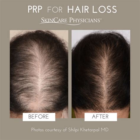 PRP – An exciting new approach to the treatment of hair loss - SkinCare ...