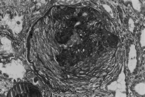 Epithelial crescent and Kimmelstiel–Wilson’s nodule. (Masson’s... | Download Scientific Diagram