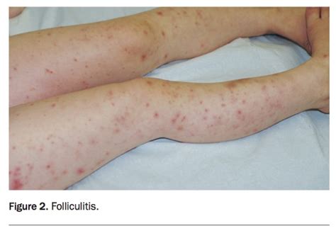 A girl with an itchy vesicular rash | Medicine Today