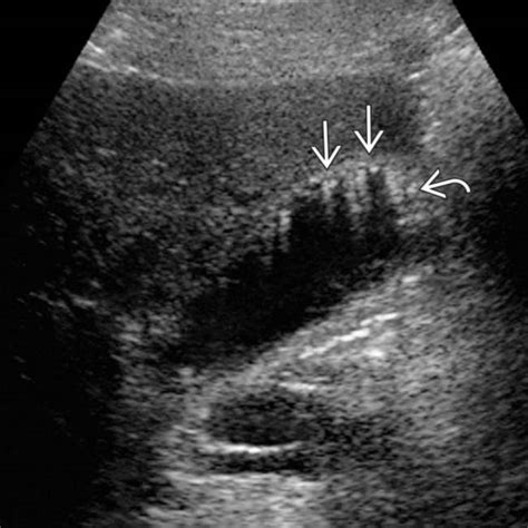 Hyperplastic Cholecystoses | Radiology Key