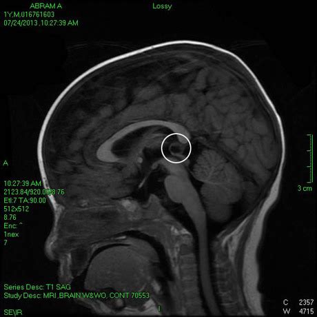 Pineal Cysts in Children | Cystic Pineal Tumor - ABRAM MAYHEM