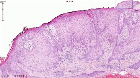 Clear Cell Acanthoma Histology