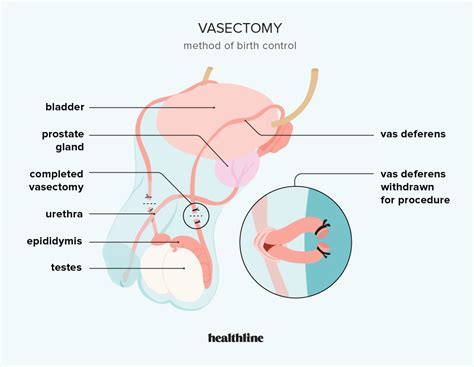 Vasectomy: Procedure, Benefits, and Risks