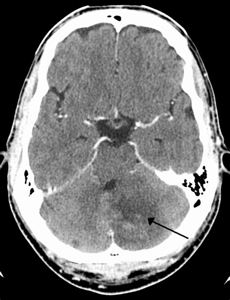 Cerebellar stroke - WikEM