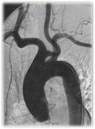 Bovine arch | Radiology Reference Article | Radiopaedia.org